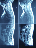 X-Ray Image of Person's Spine on Computer Screen Fotografie-Druck