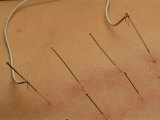 Close view of accupuncture needles treating a stomach ailment, Photographic Print
