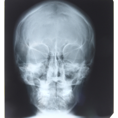 X-Ray Photograph of Person's Skull Photographic Print