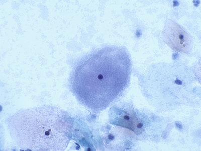 Gardnerella Vaginalis Clue