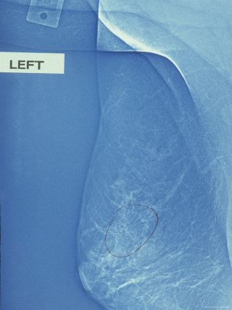 of Breast Cancer ? Pictures of Diagnosis ? Image - Denise's Mammogram