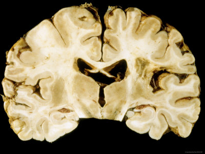 Ventricles In The Brain. Brain, Autopsy Section