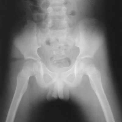 Pelvic X Ray
