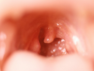 Pictures Of A Normal Throat 103