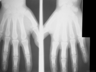 x ray hand. X-Ray Normal Right Hand