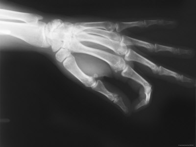 X Ray Hand. X-Ray Hand and Wrist Pinch