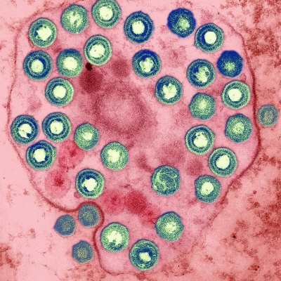 herpes simplex virus. Herpes Simplex Virus, Hsv, the Causative Agent of Fever Blisters and Cold