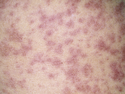 allergic reaction rash. Skin Rash from an Allergic