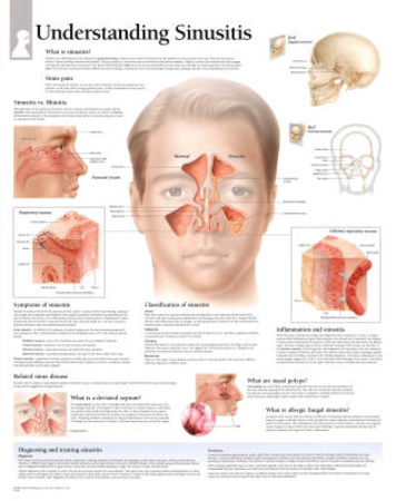 Laminated Understanding Sinusitis Educational Chart Poster Prints