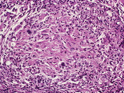 Tissue Section from a Leprosy Patient Showing the Central Nerve with Wavy Fibers Being Destroyed Photographic Print by Gladden Willis