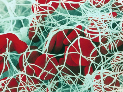 Coloured SEM of Red Blood Cells Forming a Clot Photographic Print