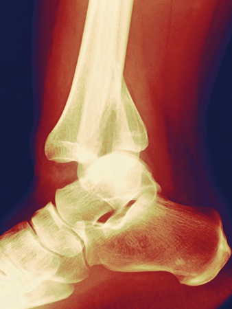 Fractured Ankle, X-ray Photographic Print by Miriam Maslo!