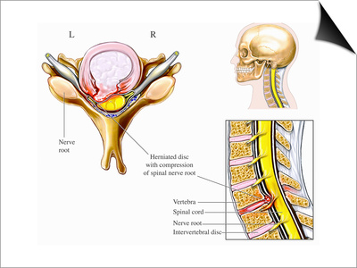 Illustration of Cervical Disc Herniation with Spinal Cord and Nerve Root Impingement Print by  Nucleus Medical Art