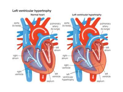 Left Ventricular Hypertrophy Posters by  Encyclopaedia Britannica