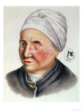 Illustration from "Traite de Chirurgie Plastique" by Antoine Jobert de Lamballe Paris, 1849 Giclee Print by Lackerbauer 