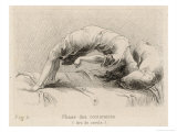 Mental Patient at la Salpetriere Going Through the Phase of Contortions Gicléedruk van P. Richer Mental Patient at la Salpetriere Going Through the Phase of Contortions Gicléedruk van P. Richer