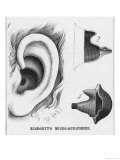 Diagrams to Show Blodgett's Micro-Audiphone Hearing Aid and How It is Inserted into the Ear reproduction procédé giclée