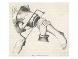 Amputation of Leg Giclee Print