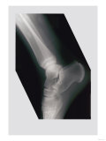 Ankle Posters