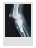 Knee Replacement Posters