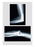 Repaired Elbow Print