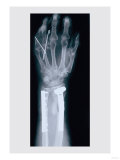 Arm and Finger Repair Prints