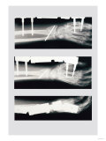 Arm with External Fixation Posters