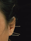 Close View of Woman Receiving Acupuncture Treatment Around Her Ears Photographic Print by O. Louis Mazzatenta