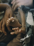 Close View of the Twisted Feet of a Starving Child Photographie par W. E. Garrett