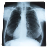 X-Ray Photograph of Person's Lungs Photographic Print
