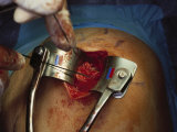 Surgery of the Shoulder Photographic Print by Scott Shapiro