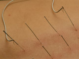 Close View of Accupuncture Needles Treating a Stomach Ailment Photographic Print by O. Louis Mazzatenta