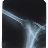 Close-up of X-Ray Photograph of Shoulder Photographic Print