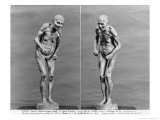 Statuette of an Old Woman with Parkinson's Disease, After 1895 Giclee Print by Paul Marie Louis Pierre Richer