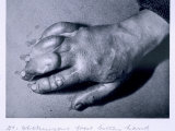 Dr. Atkinson's Frost-Bitten Hand, 1911 Photographic Print by Herbert Ponting