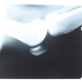Close-up of X-Ray Photograph of Elbow Photographic Print