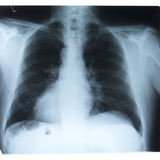 Close-up of X-Ray Photograph of Ribcage Photographic Print