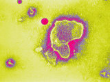 Respiratory Syncytial Virus Rsv Infection Photographic Print