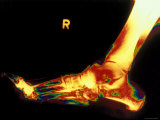 X-Ray of Foot Right Foot Photographie