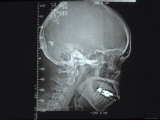 X-Ray of Human Skull Photographic Print