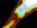 Digitized X-Ray of Knee Photographie
