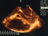 Doppler Transesoph. Echo. Ultrasound Lutembacher Syn Photographic Print