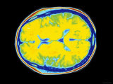 Human Brain Normal CT Scan Photographic Print