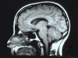Normal Head, Sagittal Magnetic Resonance Image Photographic Print