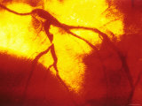 Coronary Angiogram Left Anterior Decending Artery Lámina fotográfica Coronary Angiogram Left Anterior Decending Artery Lámina fotográfica