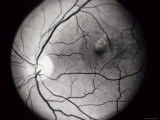 Clinical Central Serous Choroidopathy Os Photographic Print