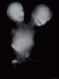 Siamese Twins X-Ray Photographie