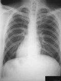 Bronchitis Chest X-Ray Adult Photographic Print