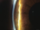 Ophthalmology, Cornea Slit-Lamp Examination Photographic Print