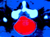 Hernia on Disc in Back Photographic Print